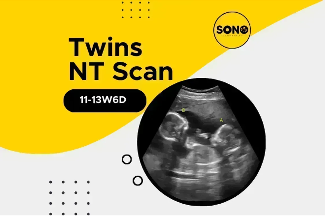 Twins NT Scan